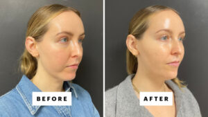 I Got Chin Filler for the First Time—See the Before-and-After Photos